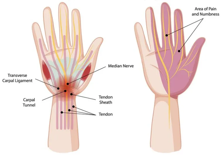The role of chiropractic care in carpal tunnel syndrome management