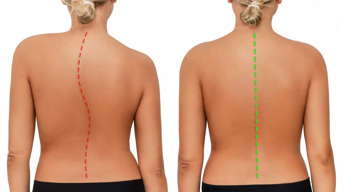 Young woman with crooked straight spine isolated white background scoliosis